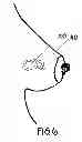 Fig. 08 - METHOD OF UTILIZING AN IMPLANT IN A HUMAN BREAST