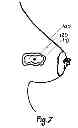 Fig. 09 - METHOD OF UTILIZING AN IMPLANT IN A HUMAN BREAST