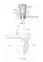 Fig. 04 - Method and apparatus for altering biomechanics of the articular joints