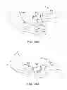 Fig. 33 - Method and apparatus for altering biomechanics of the articular joints