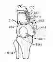 Fig. 01 - Method and apparatus for altering biomechanics of the articular joints