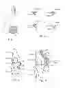 Fig. 03 - Method and apparatus for altering biomechanics of the articular joints