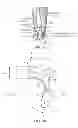 Fig. 04 - Method and apparatus for altering biomechanics of the articular joints
