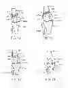 Fig. 06 - Method and apparatus for altering biomechanics of the articular joints