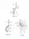 Fig. 12 - Method and apparatus for altering biomechanics of the articular joints