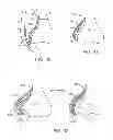 Fig. 14 - Method and apparatus for altering biomechanics of the articular joints
