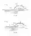 Fig. 15 - Method and apparatus for altering biomechanics of the articular joints