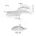 Fig. 21 - Method and apparatus for altering biomechanics of the articular joints