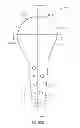 Fig. 25 - Method and apparatus for altering biomechanics of the articular joints