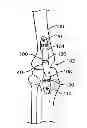 Fig. 01 - Unlinked Implantable Knee Unloading Device