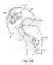 Fig. 22 - Unlinked Implantable Knee Unloading Device