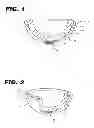 Fig. 02 - Acetabular cup assembly for multiple bearing materials