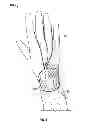 Fig. 02 - Self-wetting surgical glove