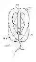 Fig. 01 - Pessaries for prolapse alleviation