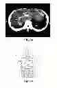 Fig. 10 - MOLDED ARTICLE PRODUCING METHOD AND MOLDED ARTICLE