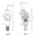 Fig. 09 - Fixed hybrid dental attachment device and methods of using same