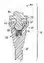 Fig. 01 - Fixed hybrid dental attachment device and methods of using same