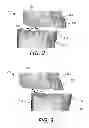Fig. 03 - Fabrication of maxillofacial surgical splints