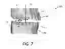 Fig. 07 - Fabrication of maxillofacial surgical splints