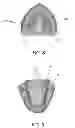 Fig. 08 - Fabrication of maxillofacial surgical splints