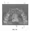 Fig. 09 - Fabrication of maxillofacial surgical splints