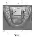 Fig. 10 - Fabrication of maxillofacial surgical splints
