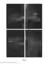 Fig. 03 - TESTOSTERONE-ANASTROZOLE (T + A) COMBINATION IMPLANTS IN THE NEO-ADJUVANT, LOCAL AND SYSTEMIC THERAPY OF NEWLY DIAGNOSED, PREVIOUSLY UNTREATED BREAST CANCER