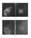 Fig. 07 - TESTOSTERONE-ANASTROZOLE (T + A) COMBINATION IMPLANTS IN THE NEO-ADJUVANT, LOCAL AND SYSTEMIC THERAPY OF NEWLY DIAGNOSED, PREVIOUSLY UNTREATED BREAST CANCER