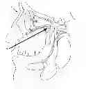 Fig. 01 - Method, composition and kit for treating frequent headaches