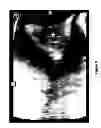 Fig. 06 - Sonography Guided Embryo Transfer For In Vitro Fertilization
