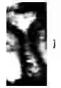 Fig. 07 - Sonography Guided Embryo Transfer For In Vitro Fertilization