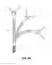 Fig. 06 - Method and system for transhiatal esophagectomy