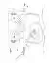 Fig. 152 - Convertible surgical access port