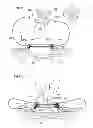 Fig. 95 - Convertible surgical access port