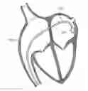 Fig. 01 - IRRIGATED CATHETER