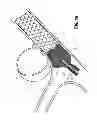 Fig. 06 - MICROCATHETER