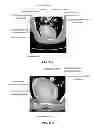 Fig. 17 - AUTOMATED DETERMINATION OF ARTERIAL INPUT FUNCTION AREAS IN PERFUSION ANALYSIS