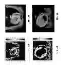 Fig. 18 - AUTOMATED DETERMINATION OF ARTERIAL INPUT FUNCTION AREAS IN PERFUSION ANALYSIS