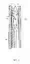 Fig. 02 - Biopsy needle with a laterally expandable distal portion