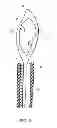 Fig. 03 - Biopsy needle with a laterally expandable distal portion