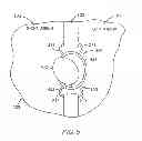 Fig. 11 - DEVICE AND METHOD FOR CONTROLLING IN-VIVO PRESSURE