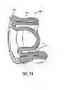 Fig. 45 - Reconstitution devices