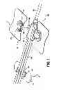 Fig. 02 - Catheter securement devices