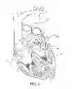 Fig. 03 - Lasso catheter with tip electrode
