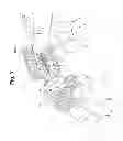 Fig. 04 - Completely resorbable connective tissue distraction devices and techniques