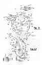 Fig. 02 - Patient-specific acetabular guide for anterior approach