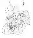 Fig. 03 - Patient-specific acetabular guide for anterior approach