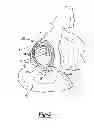 Fig. 06 - Patient-specific acetabular guide for anterior approach