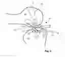 Fig. 04 - Anatomic femoral guide