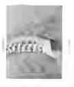 Fig. 03 - Determining and placing spinal implants or prostheses